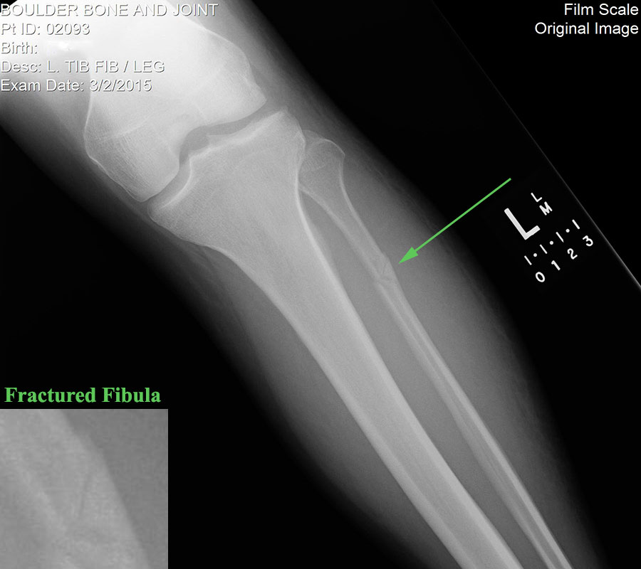 grass fractured fibula